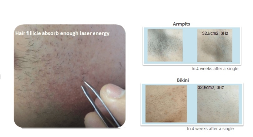 Лазерное Удаление волос- VCA LASER — DM 005